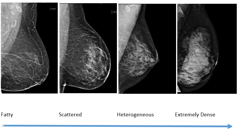 breast-density illustration