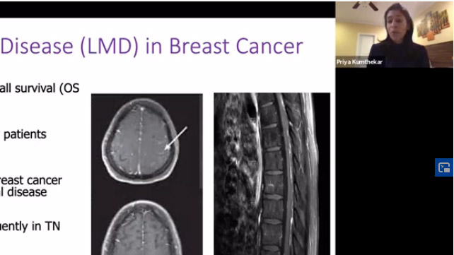 Grand Rounds Webinar: Leptomeningeal Disease: Overcoming Treatment Challenges through Novel Clinical Trials